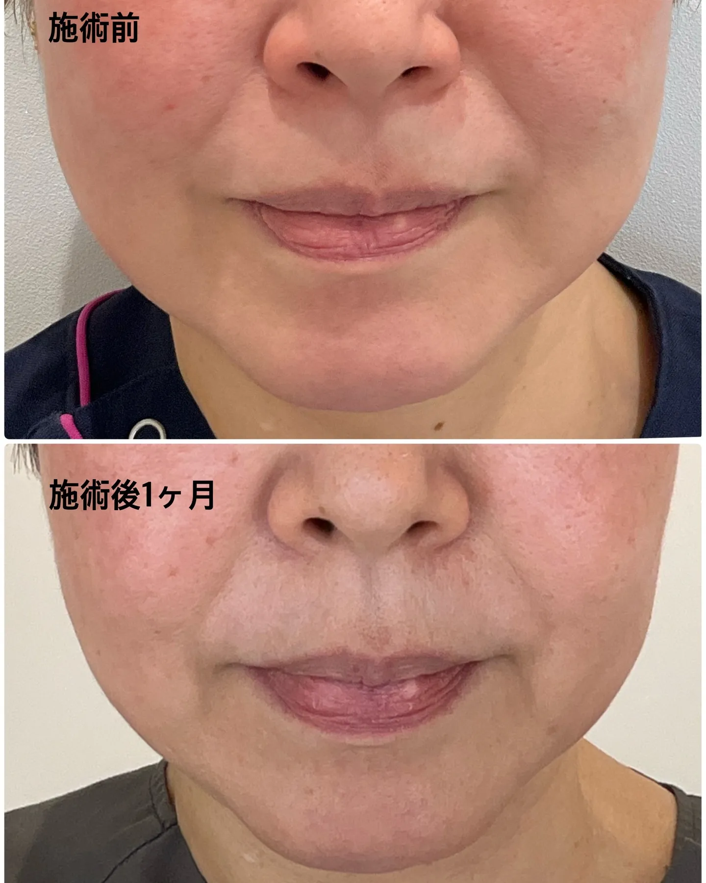 ショッピングリフトの経過をお届けします✨ 