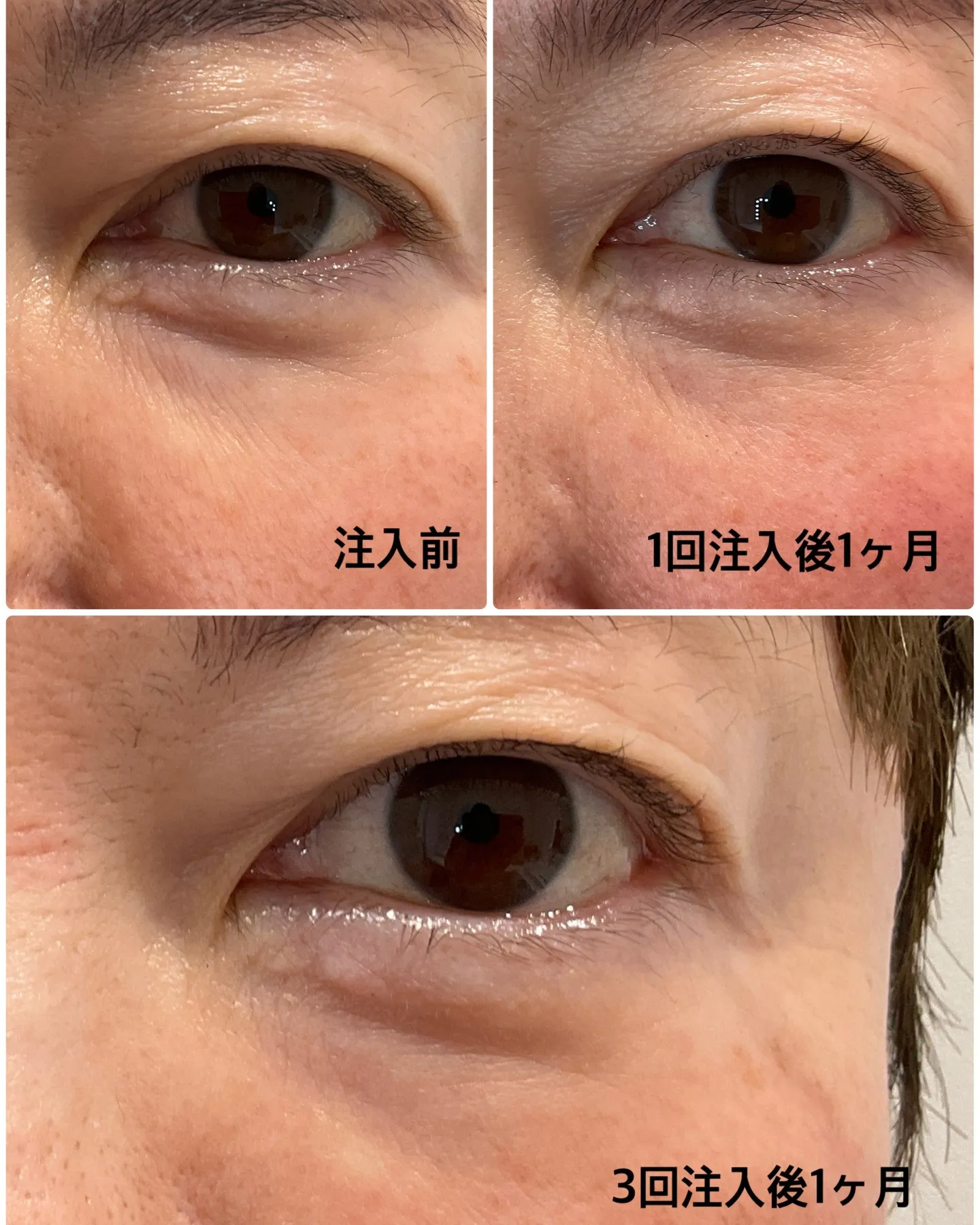 目元の小じわが気になる方💧✨。