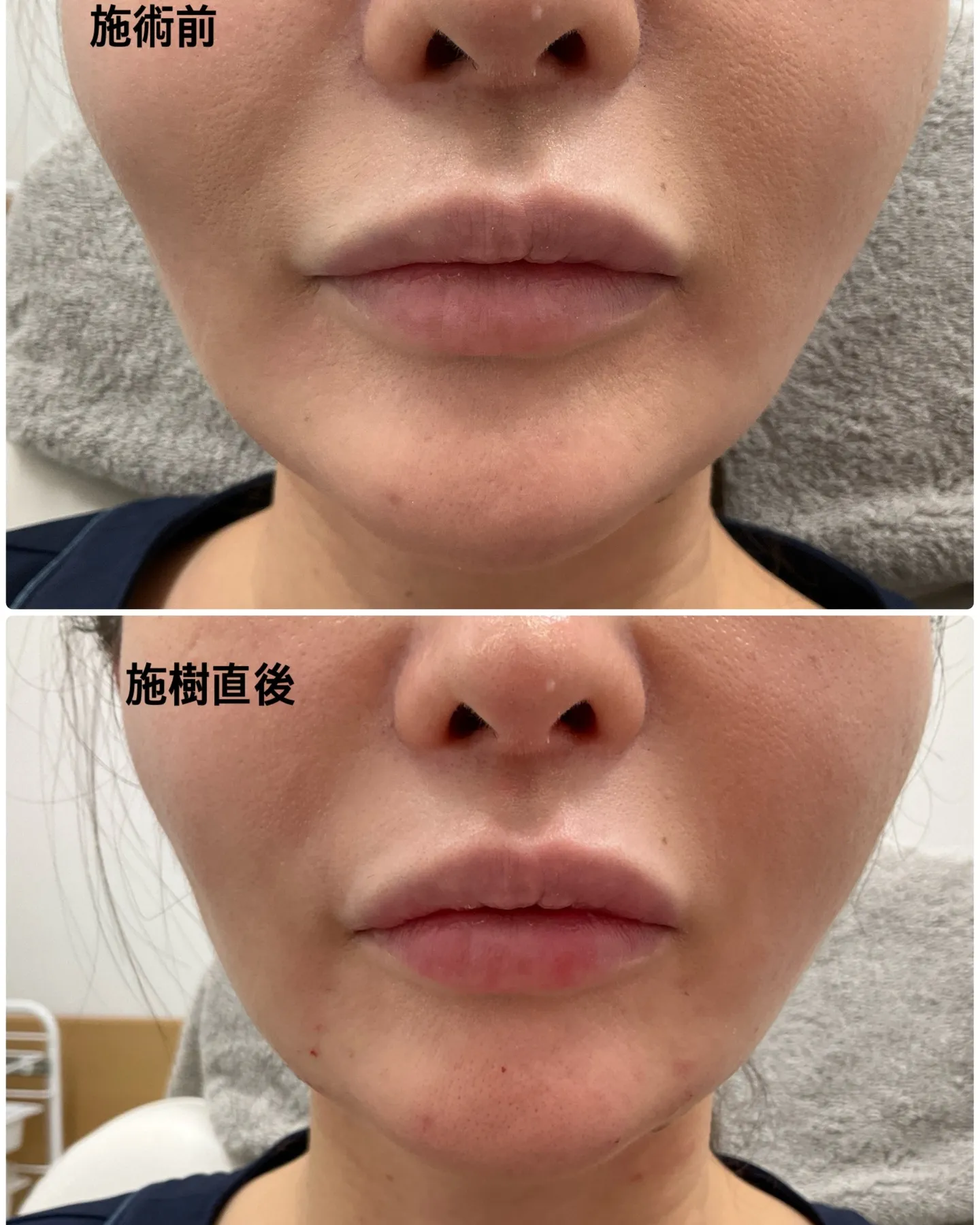 ✨ショッピングリフト✨の症例をご紹介します