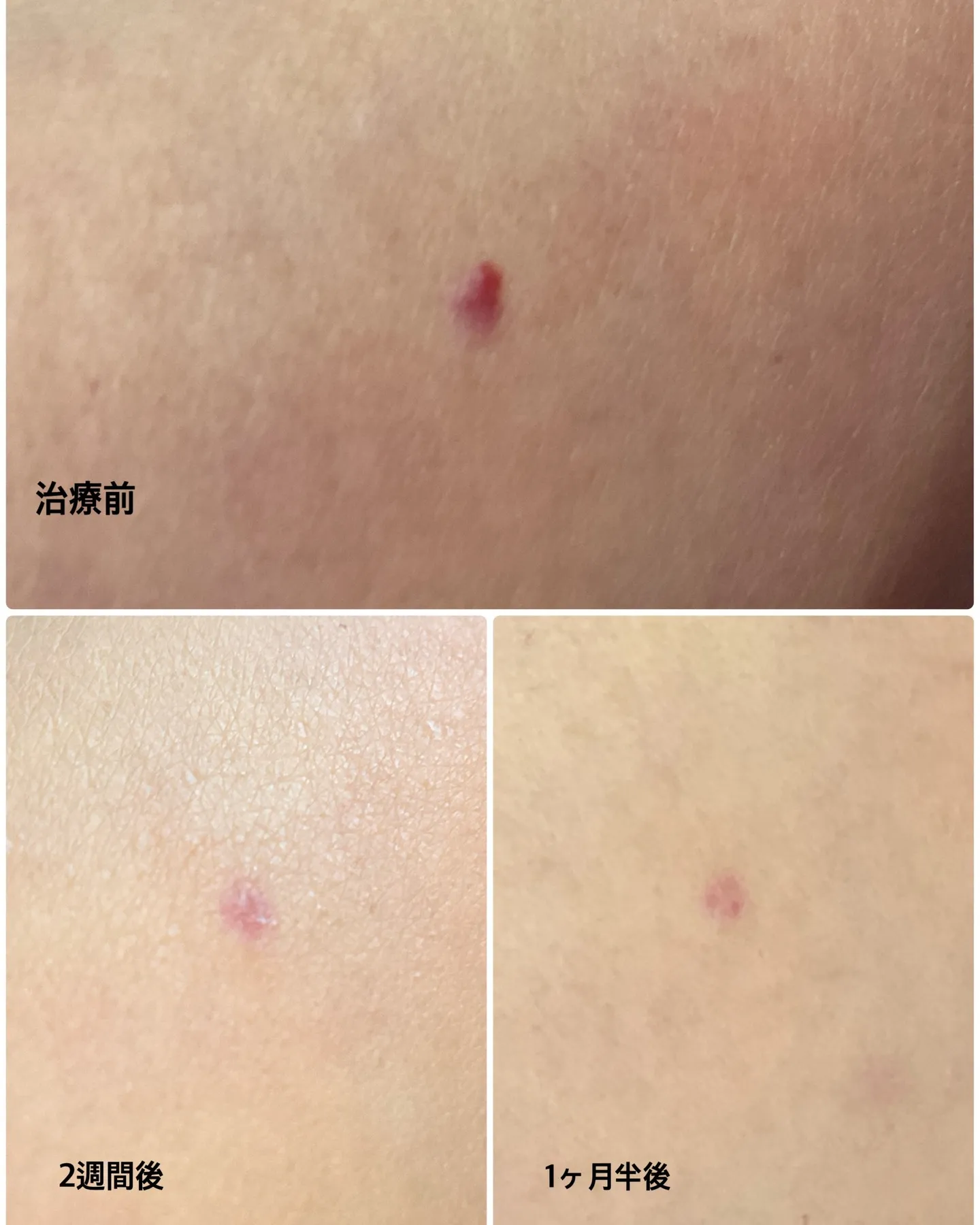 🌸【炭酸ガスレーザー後の経過報告です】🌸