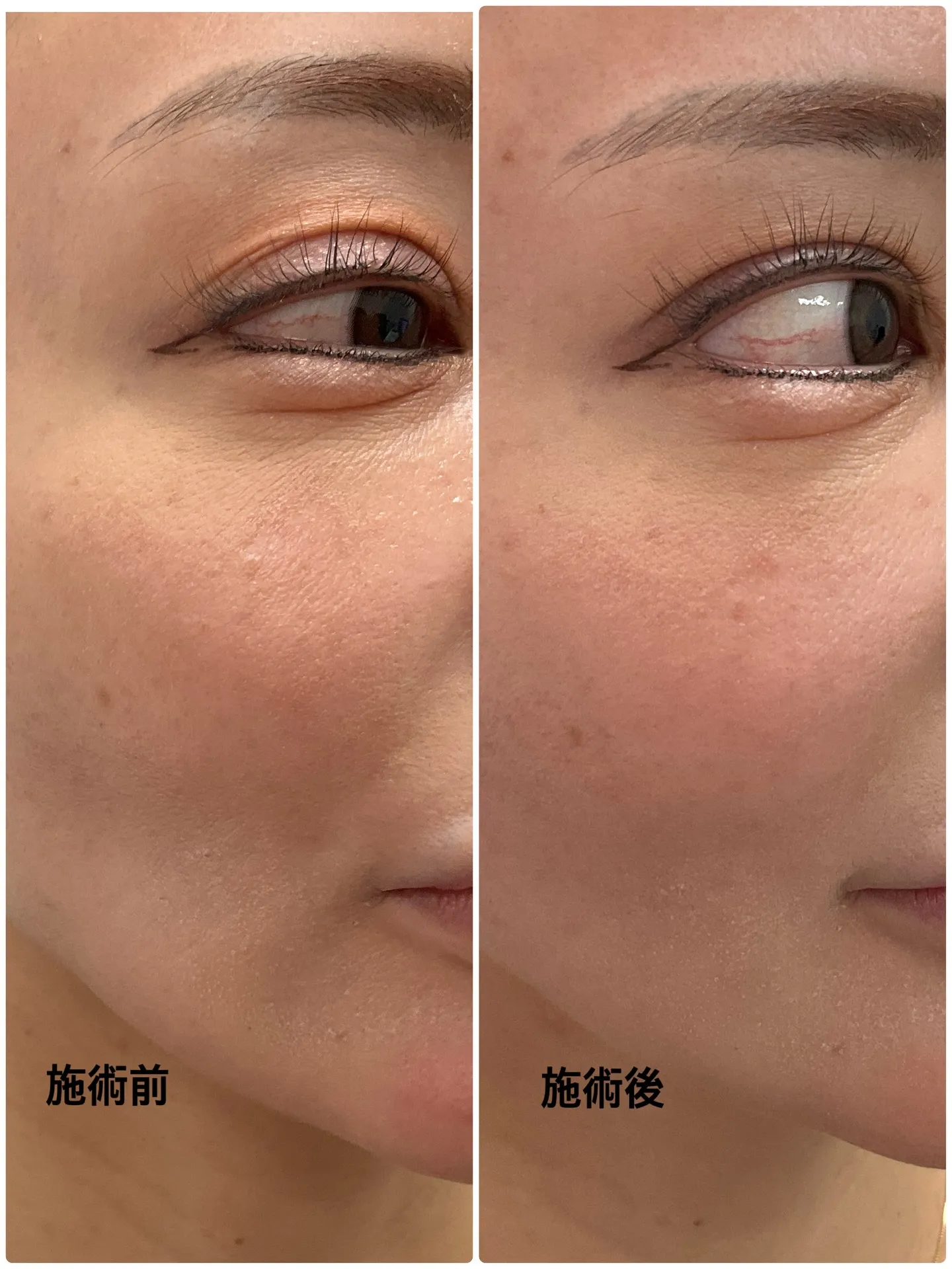 当院で取り扱っているヒアルロン酸(リデンシティⅡ)を頬コケし...