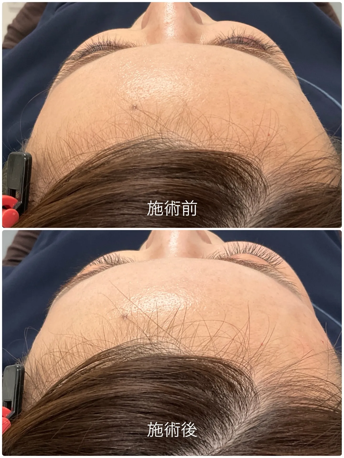 当院で取り扱っているヒアルロン酸（リデンシティⅡ）を額の痩せ...