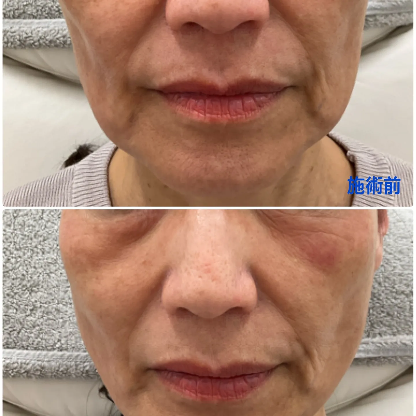 🌟糸リフト施術レポート🌟