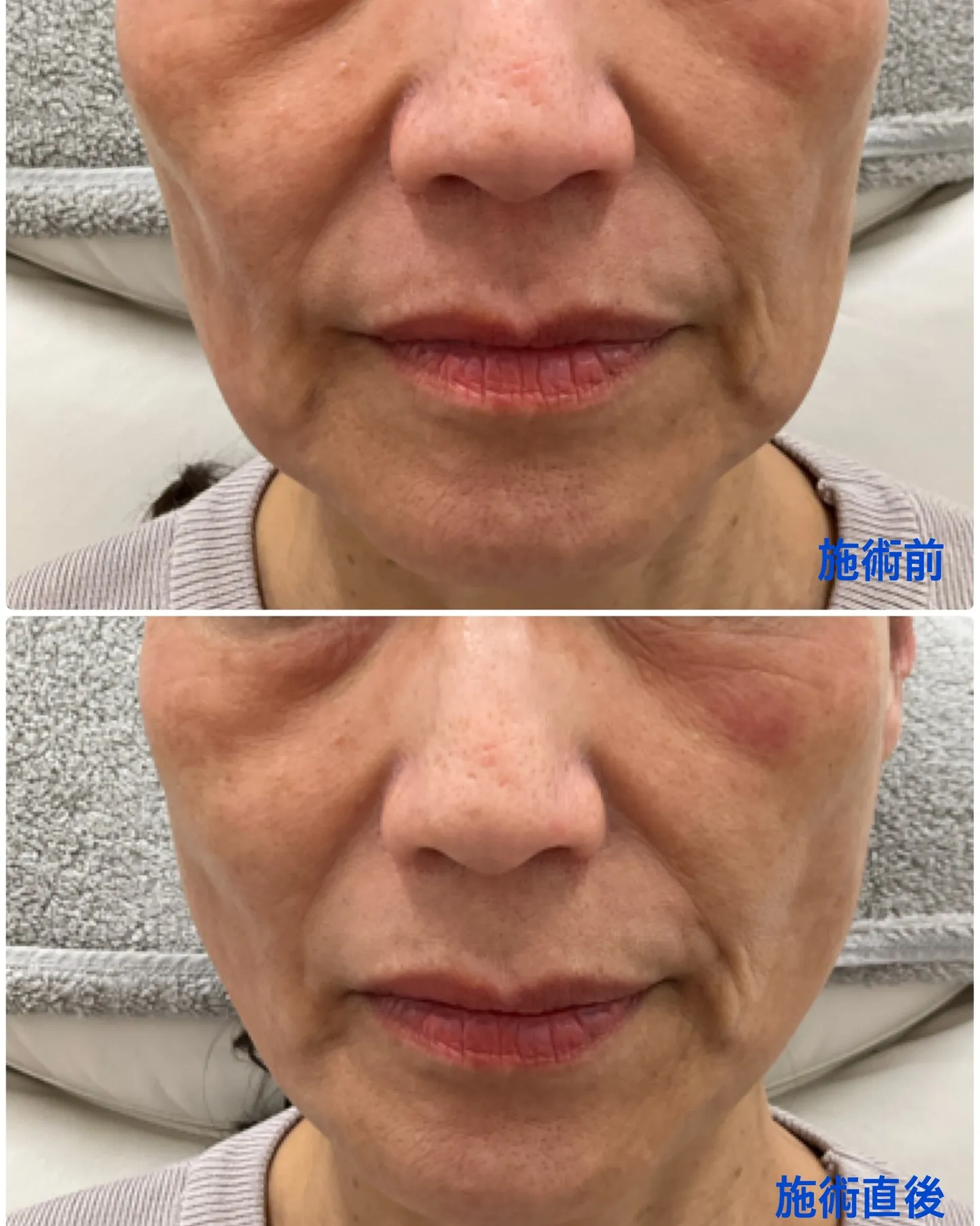 フェイスラインのたるみや頬のコケが気になるとご相談を頂いた患...