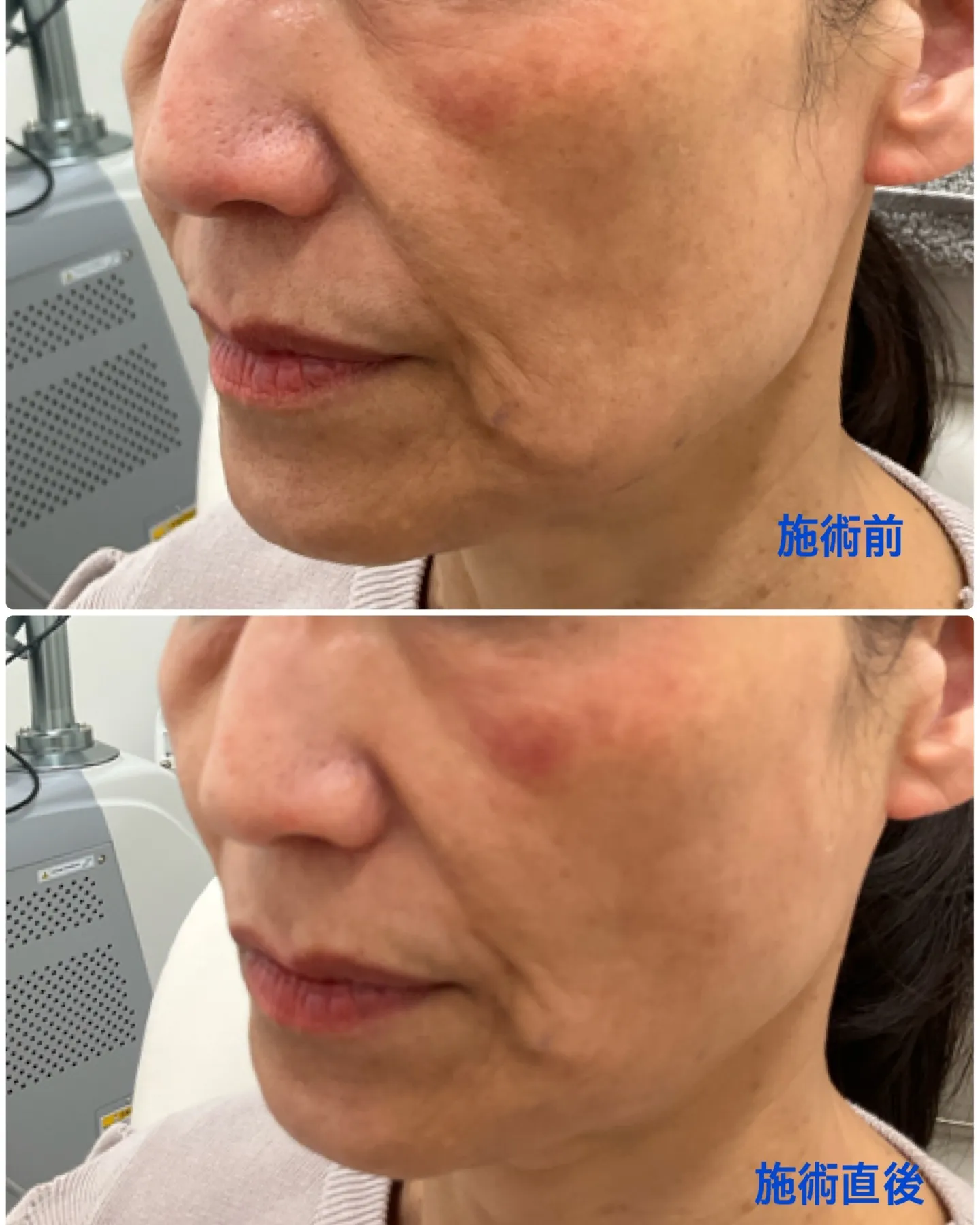 フェイスラインのたるみや頬のコケが気になるとご相談を頂いた患...