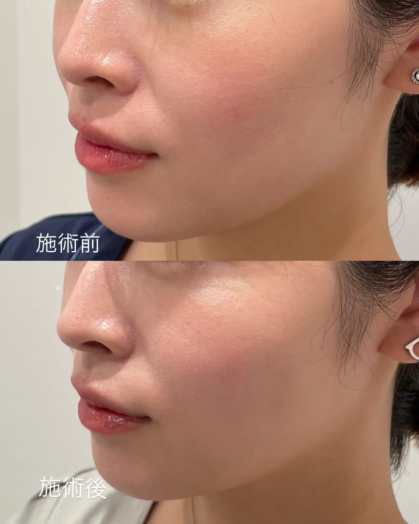 スタッフが糸リフトしました