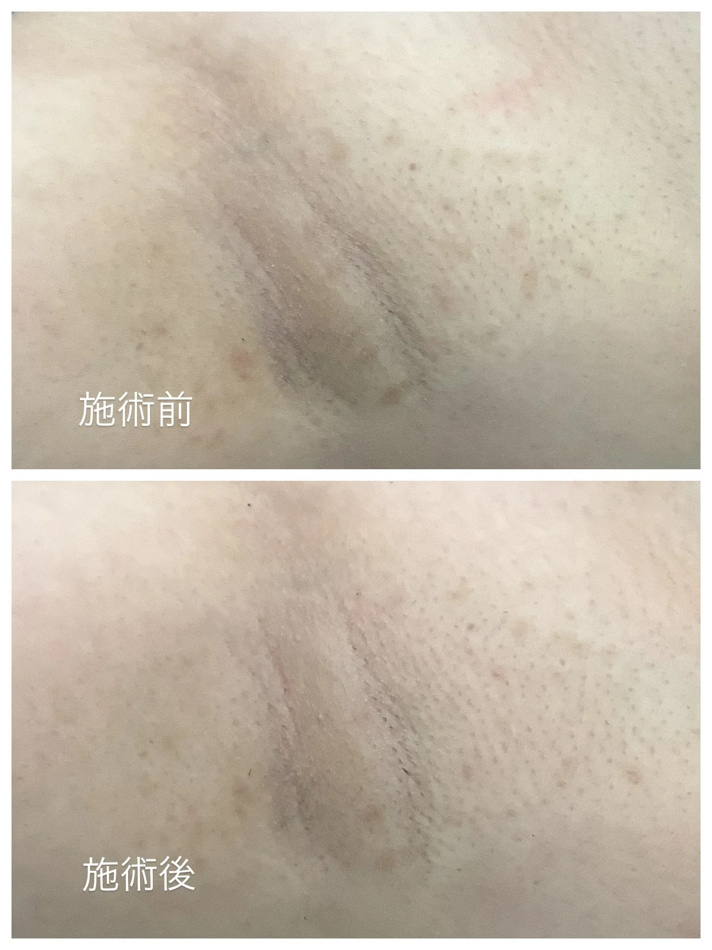 デリケートゾーン用ピーリング