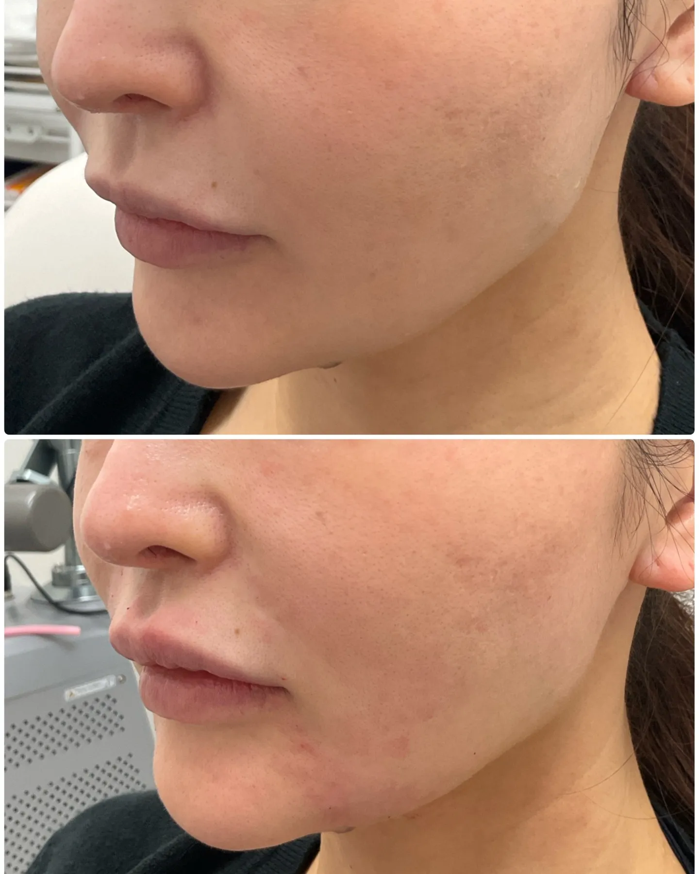 ✨ショップリフトの新しい症例をご紹介いたします✨今回の施術で...