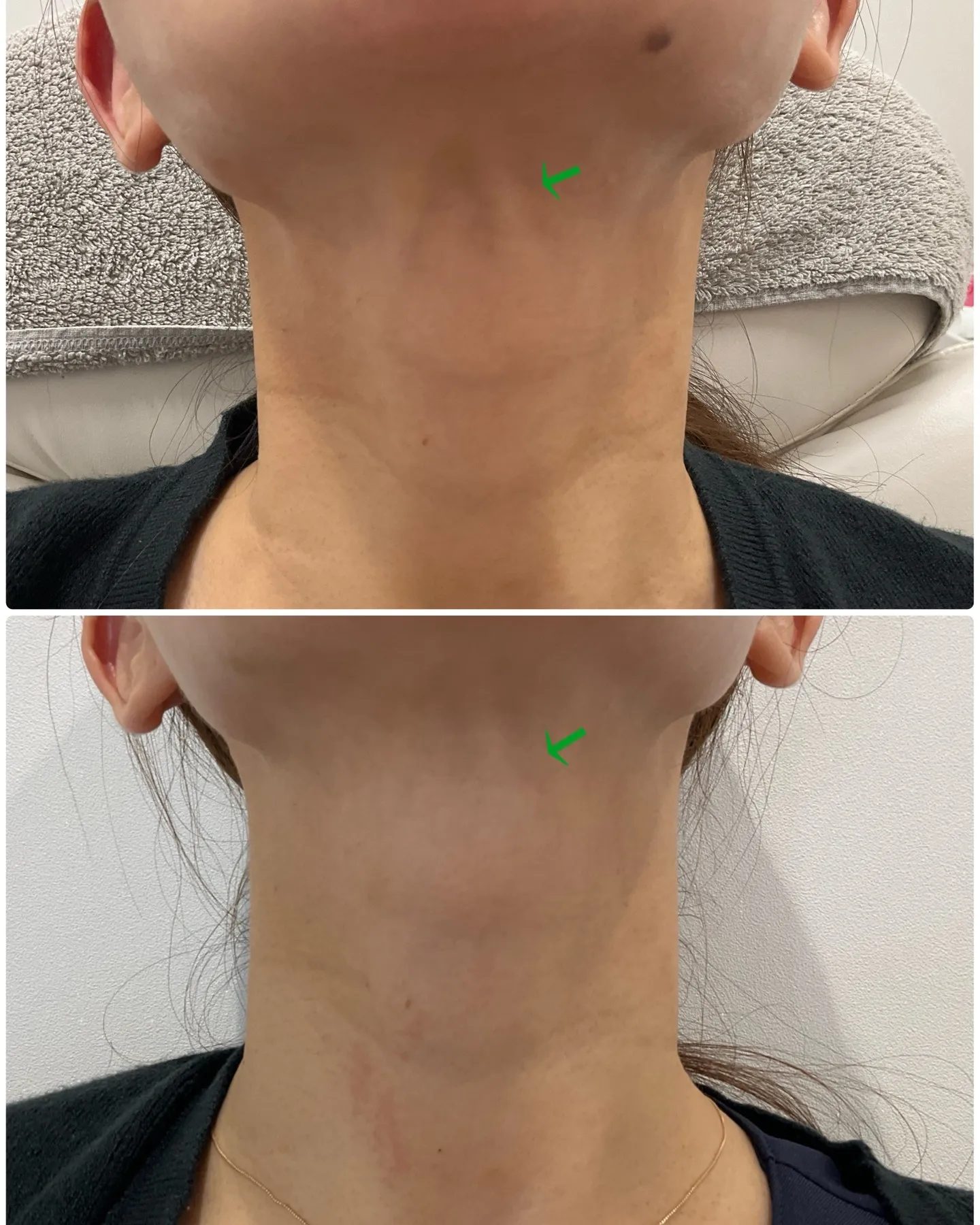✨首の横ジワが気になる患者様に広頚筋ボトックスを実施しました...