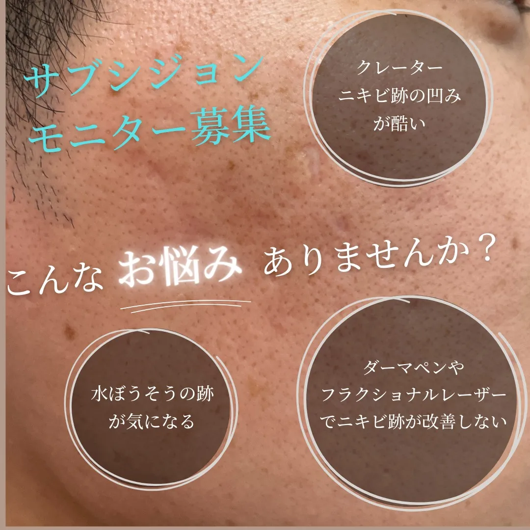 陥凹のひどいニキビ跡や水ぼうそうの跡でお悩みの方に向けて、サ...