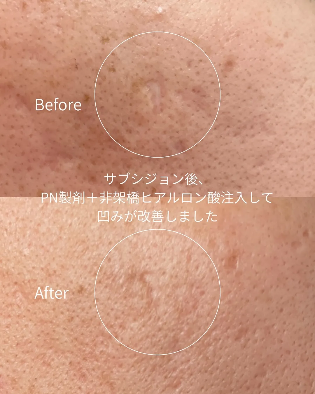 クレーターになったニキビ跡にサブシジョン治療をした患者様のビ...