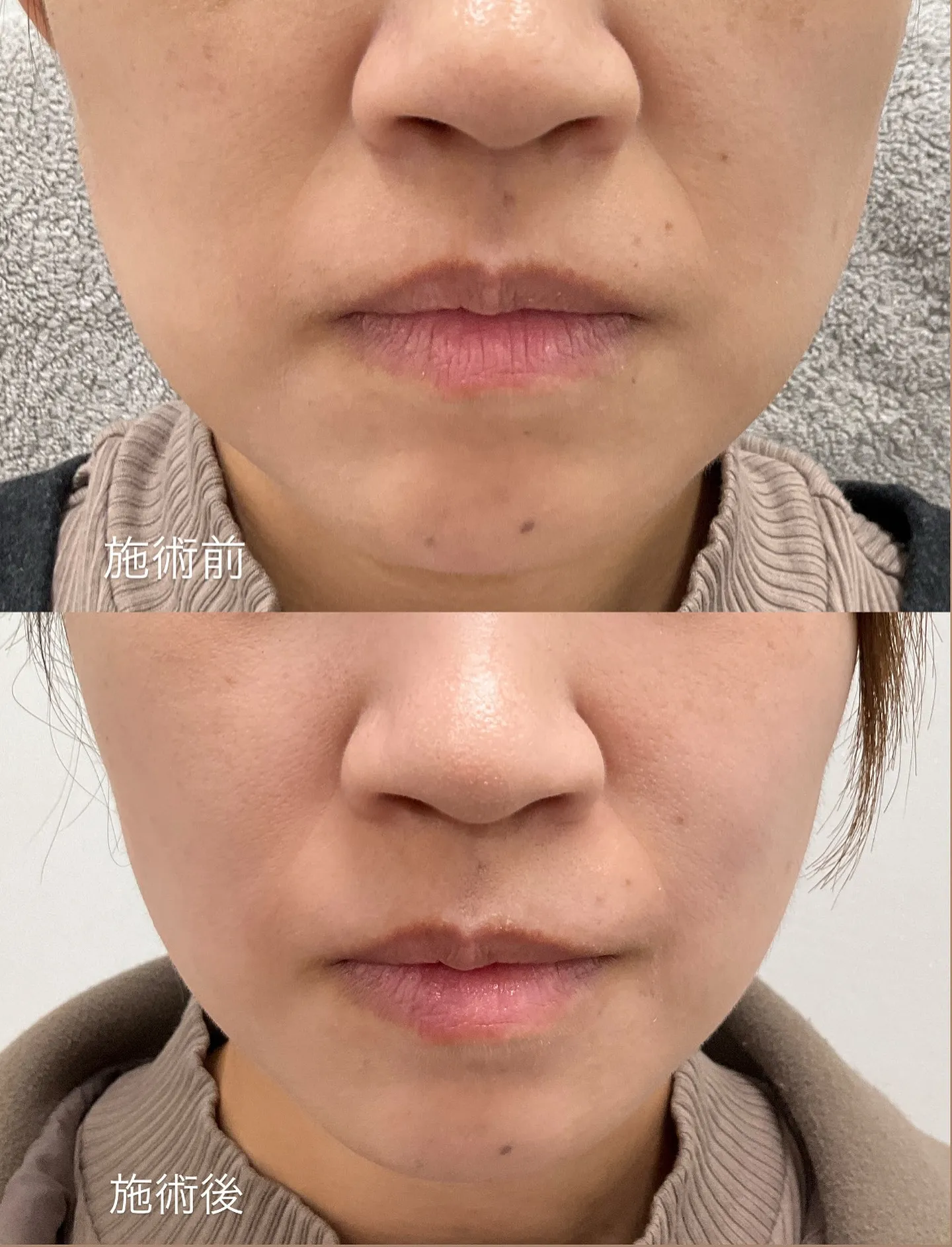 糸リフトのモニター様のビフォーアフターです