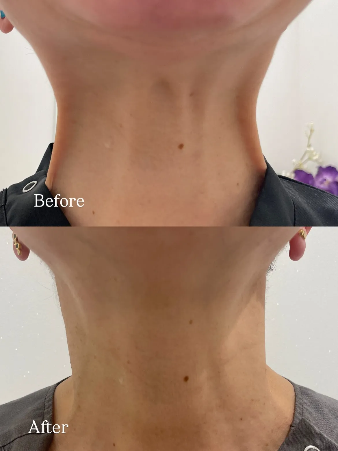 広頚筋ボトックスの経過です。