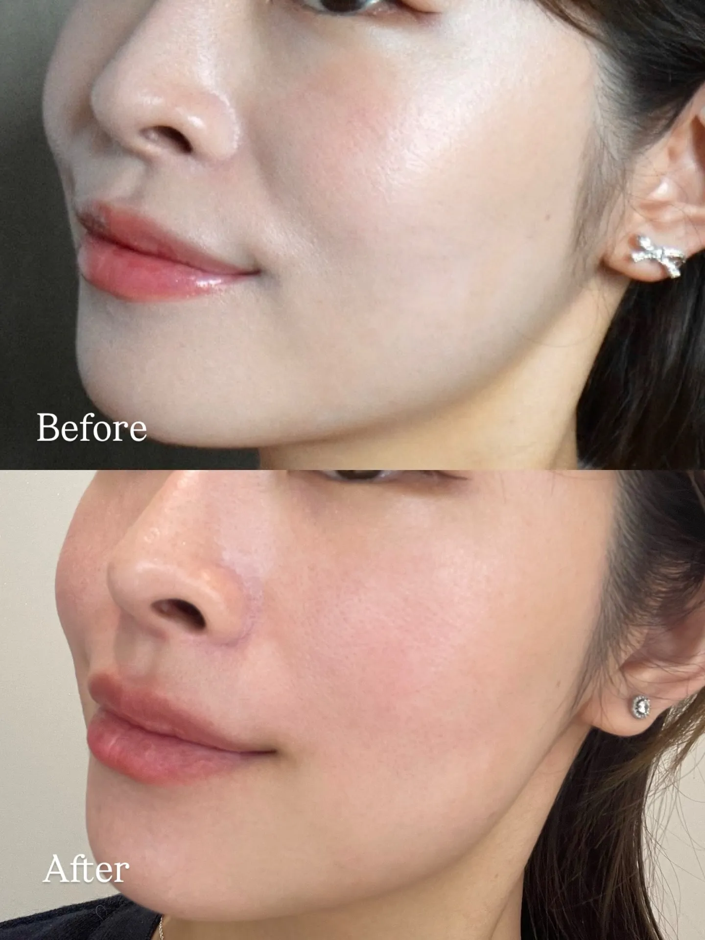 鼻翼挙筋と鼻筋にボトックスを打ってみました。