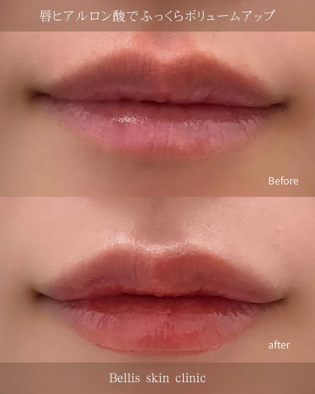 唇ヒアルロン酸の症例です💋