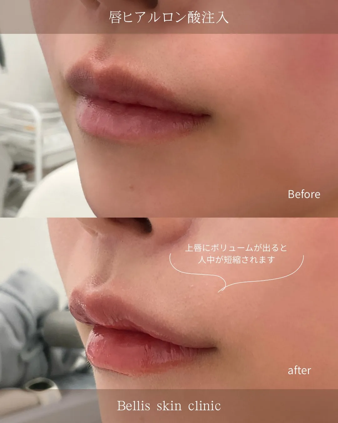唇ヒアルロン酸の症例です💋