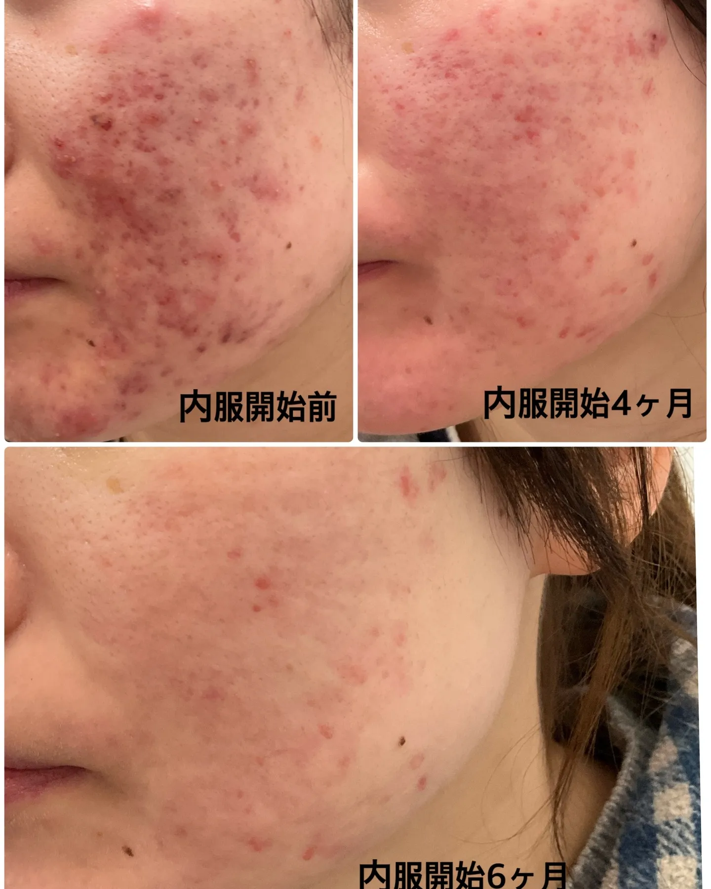 🌟ニキビでお悩みの皆様🌟