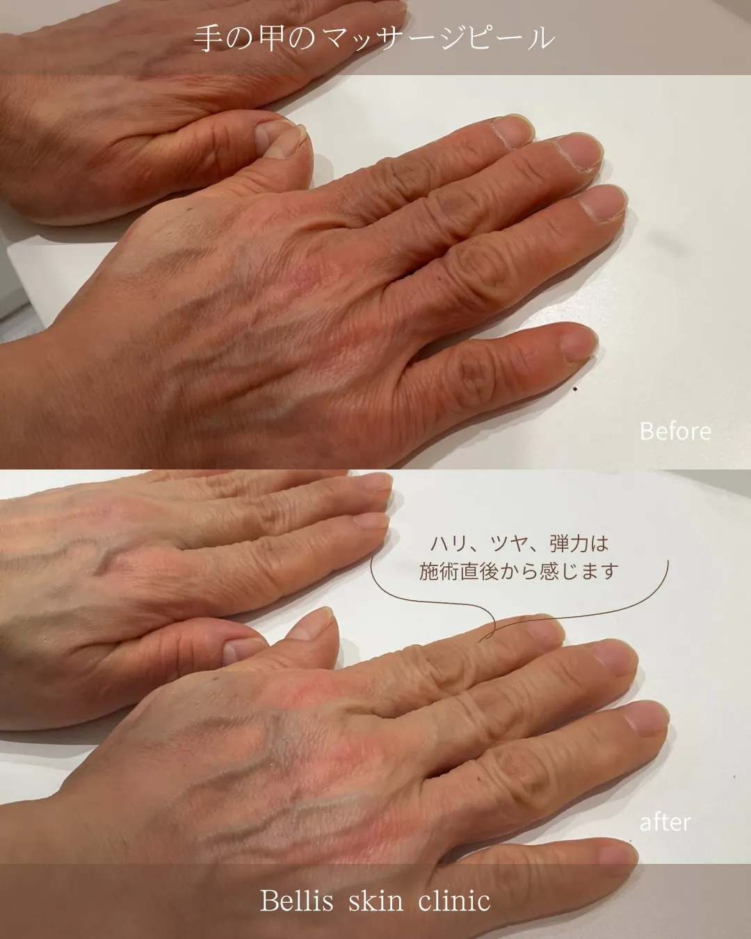 手の甲のマッサージピール🌸
