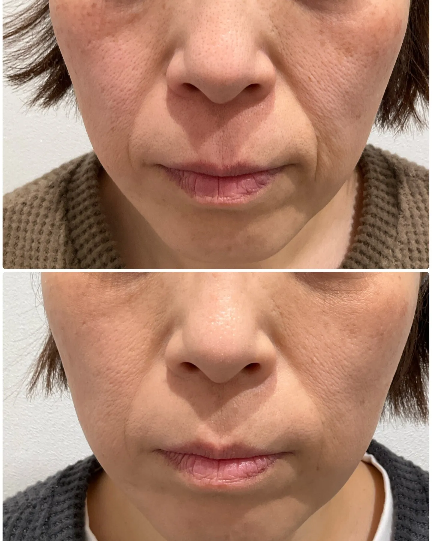 ✨伸展性のあるヒアルロン酸「レスチレンディファイン」をご紹介...