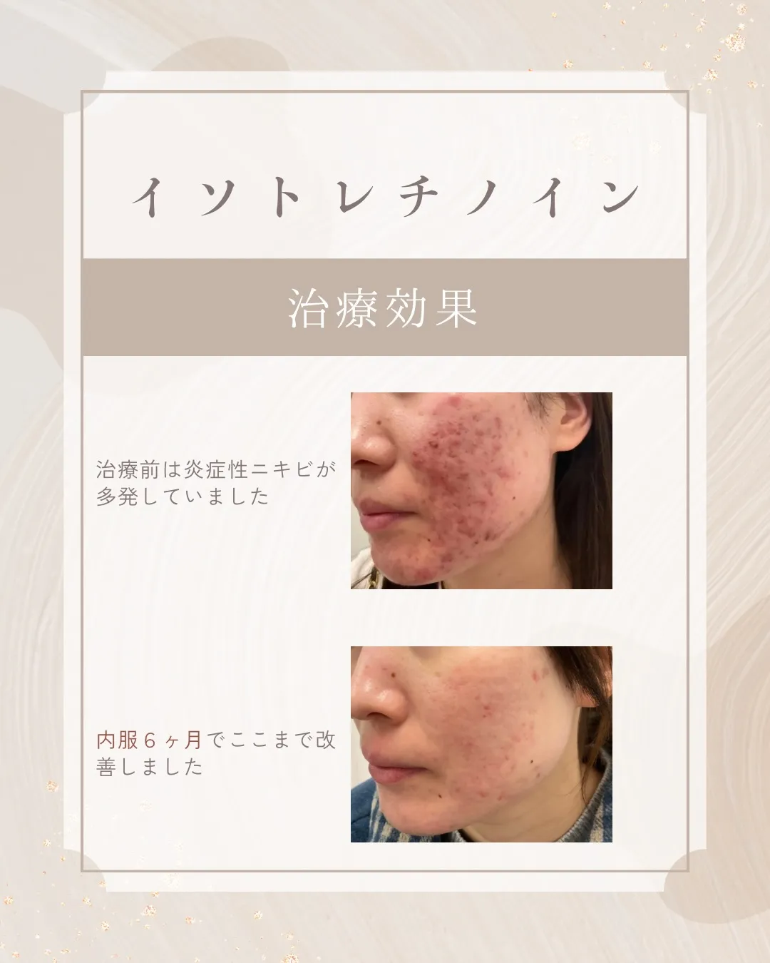 難治性・重症性ニキビ治療として知られている