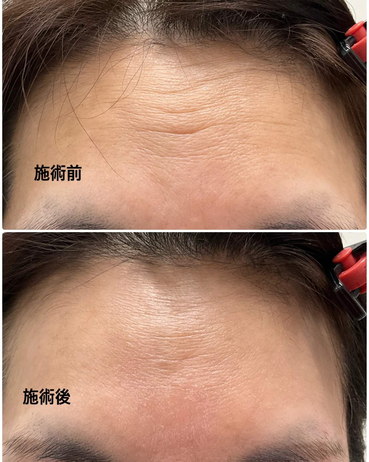 あなたの肌に刻まれた深いしわ、もうあきらめてしまいましたか？...