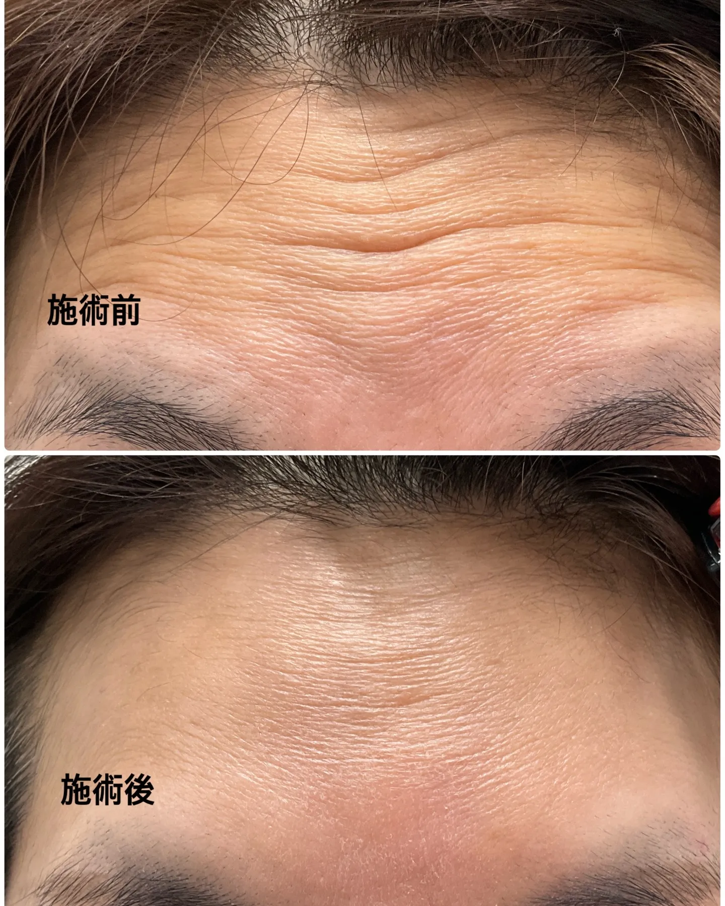 あなたの肌に刻まれた深いしわ、もうあきらめてしまいましたか？...