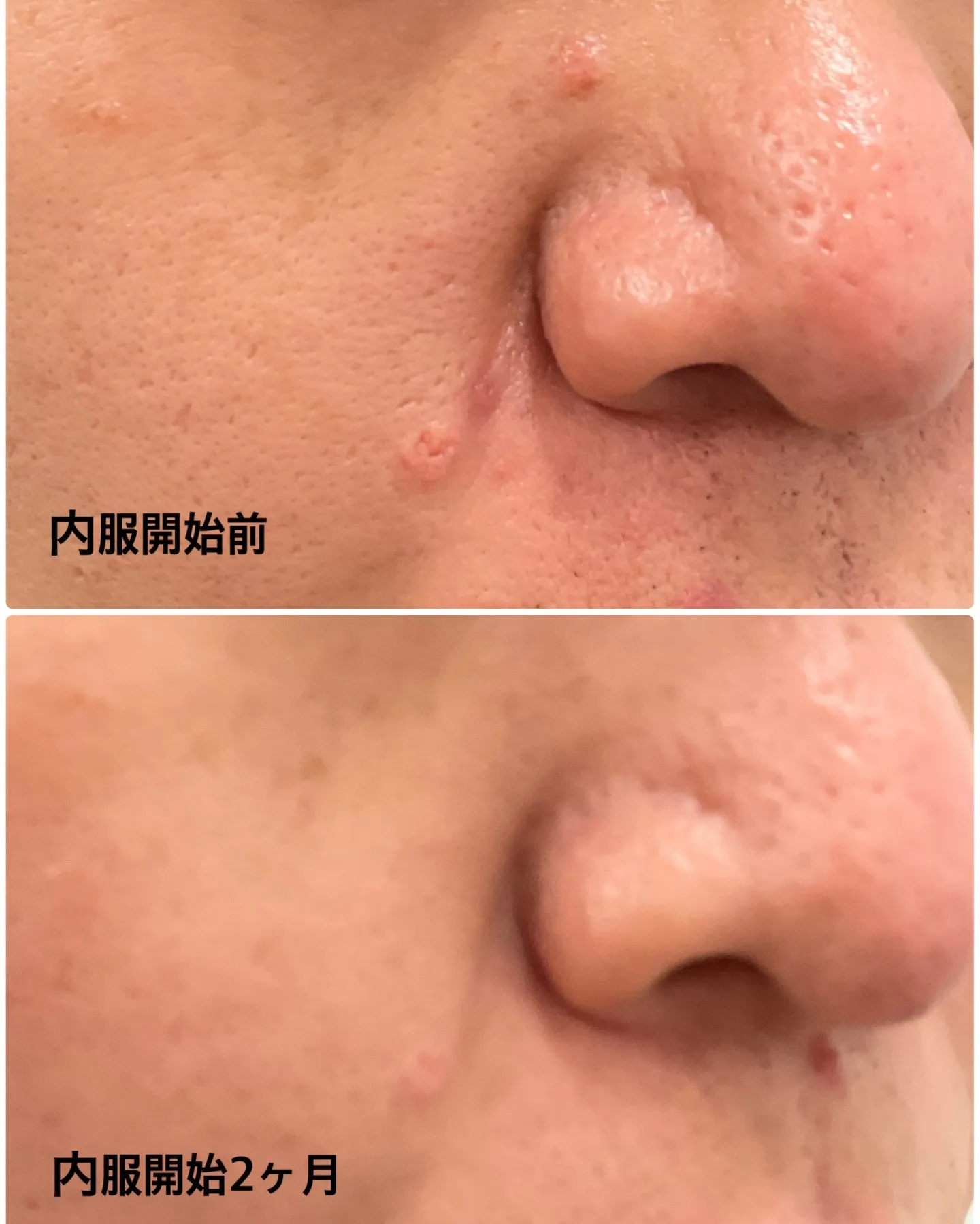 脂腺増殖症は、特に30代から40代以降の方に多く見られる疾患...