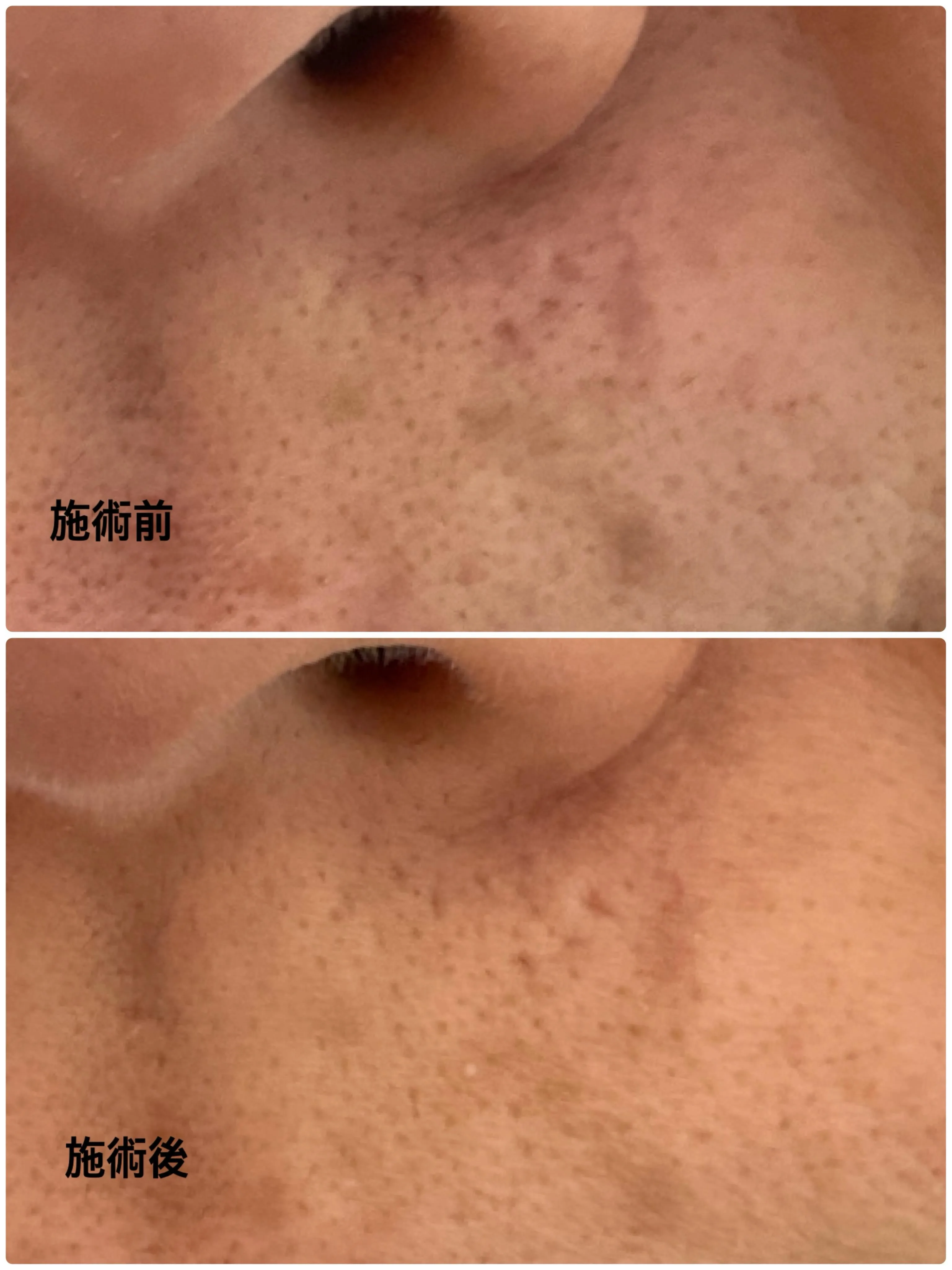 キュアジェットモニターの患者様です