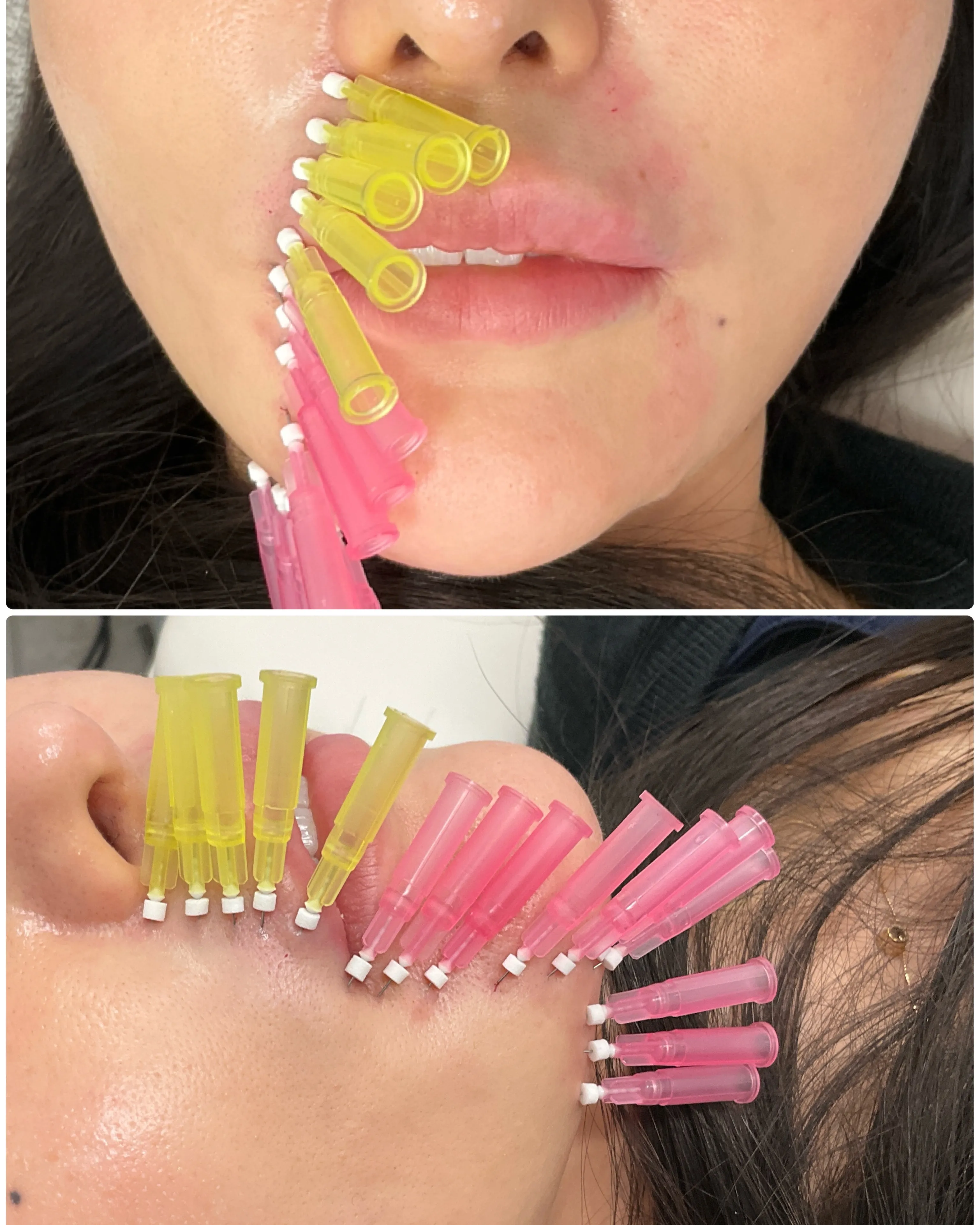 ショッピングリフトとは、医療用の溶けるごく細糸を皮膚の浅い層...