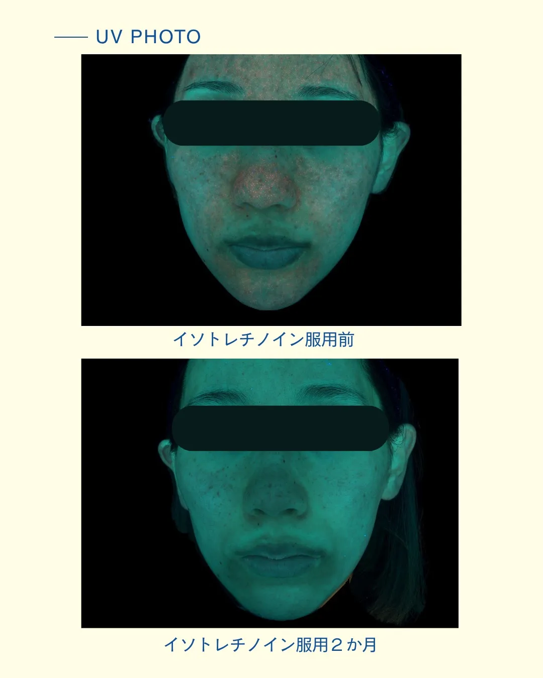 お顔の赤みを気にされて受診された患者様をご紹介します。