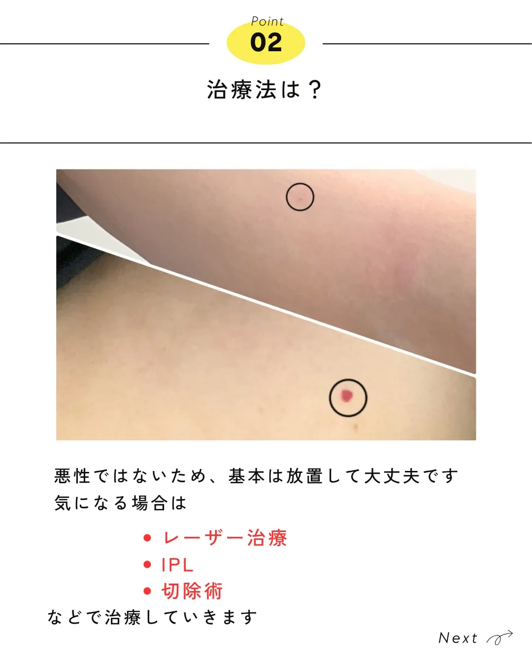 🍒【チェリースポット(老人性血管腫)って知ってる?】🍒
