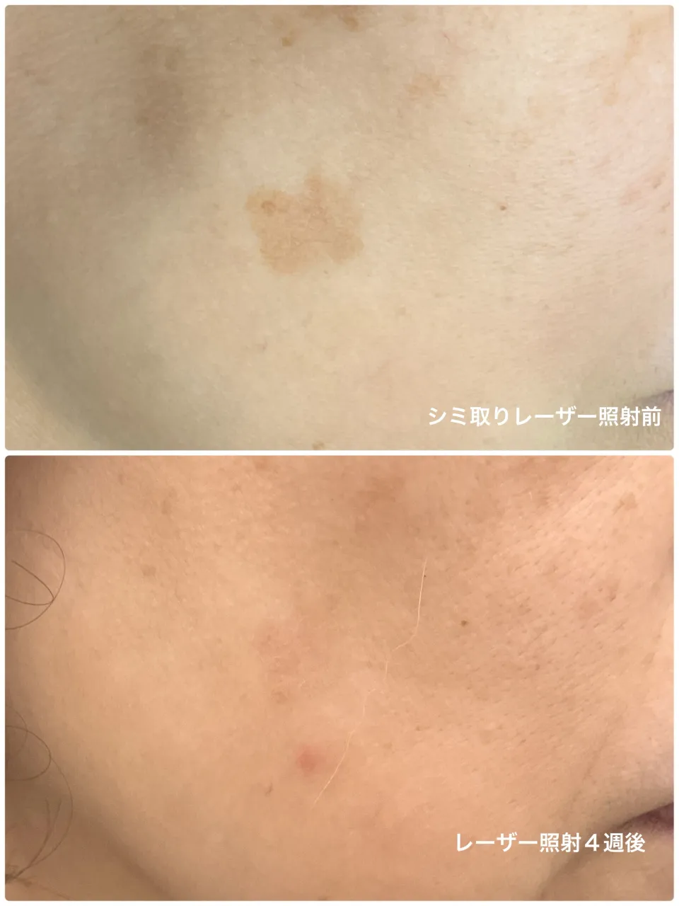 シミ取りレーザー照射4週後の症例です。