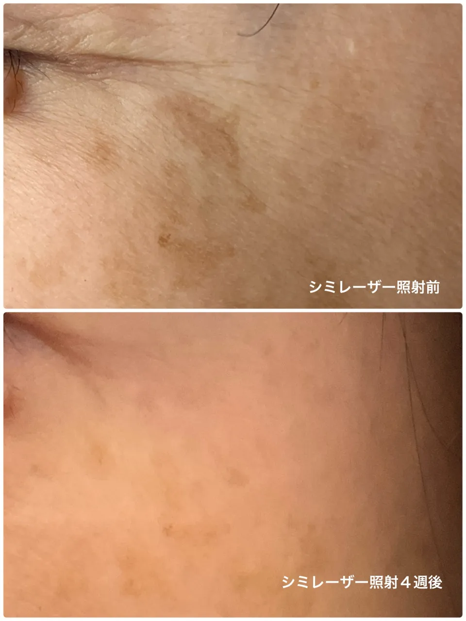 シミ取りレーザー照射4週後の症例です。