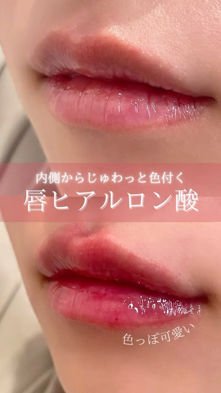 新しく色付きのヒアルロン酸（ティントフィラー）が登場💋𓂃