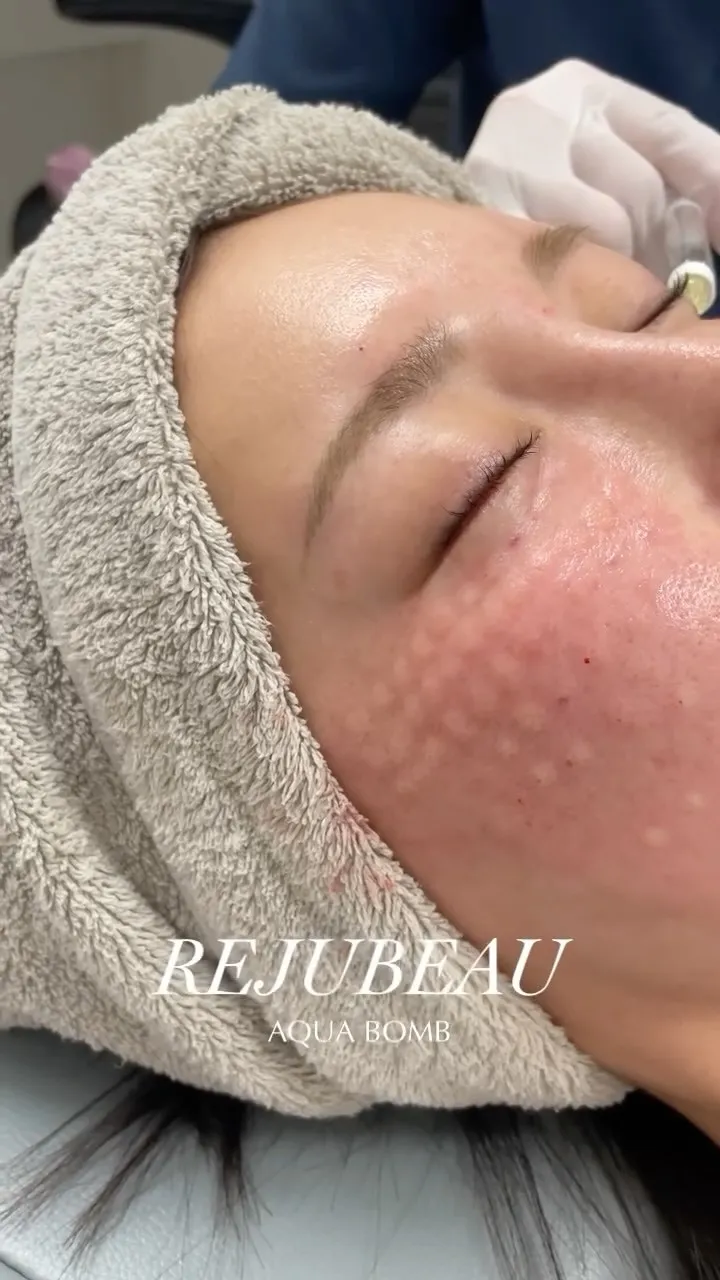 肌育注射、リジュビューの施術風景です📸