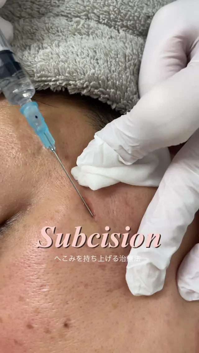 深いニキビ跡（クレーター）でお悩みの方にオススメの