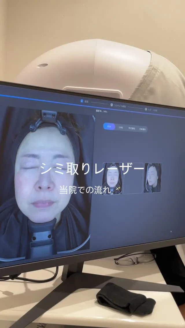 当院でのシミ取りレーザーの流れです🪄✨