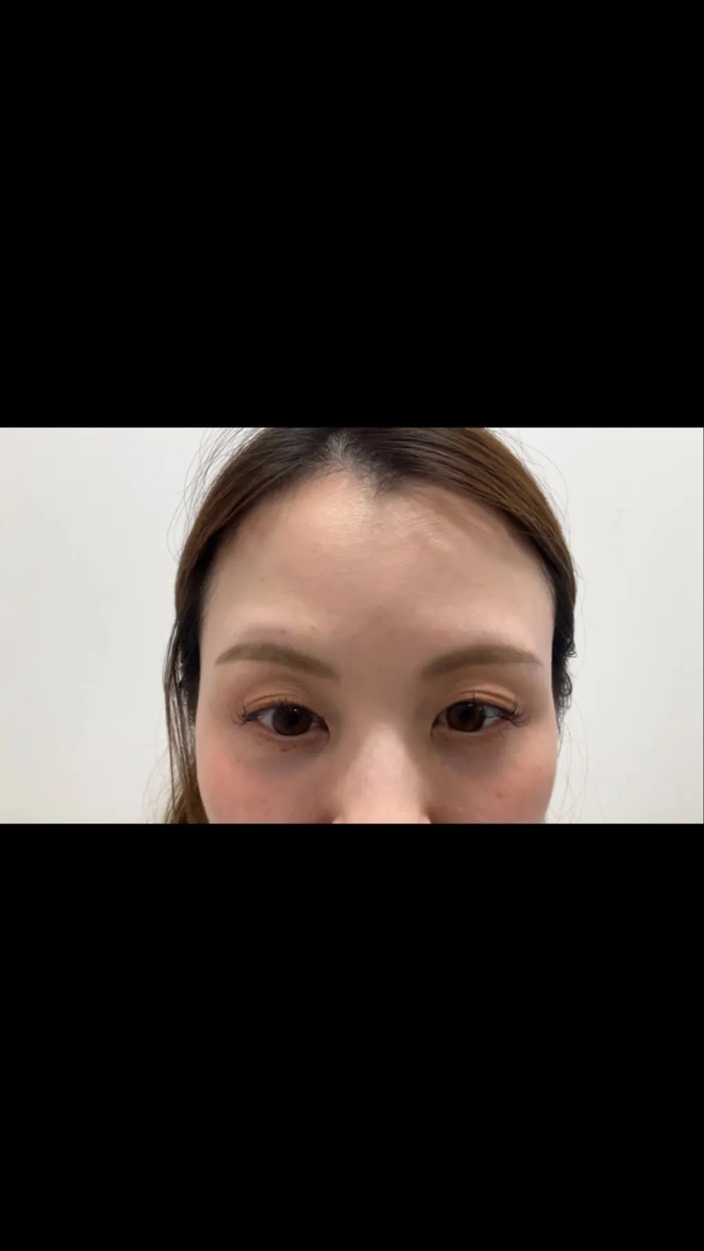 鏡を見るたびに気になっていた、眉間と額のシワ。